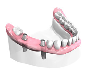 Implant dentaire Saint Malo