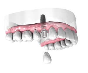 Implant dentaire Saint Malo